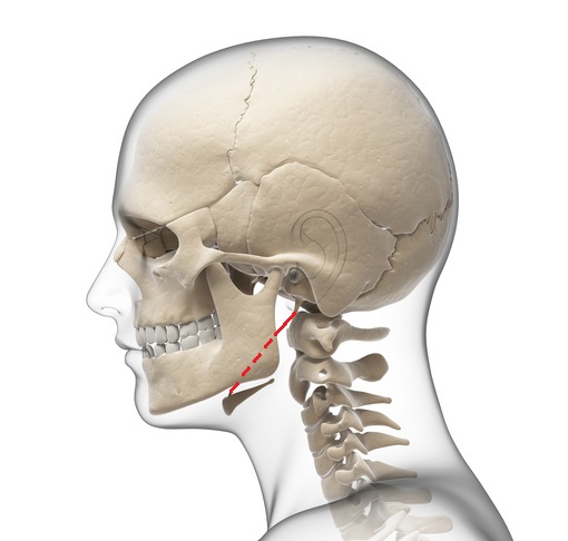 茎突舌骨靭帯断裂の症例_e0146240_19531152.jpg
