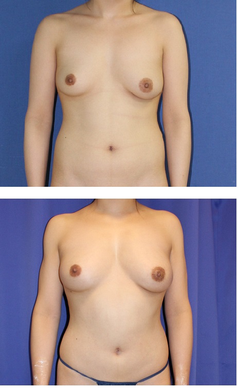 脂肪移植豊胸　右胸3回　左胸2回　術後2か月_d0092965_4155535.jpg