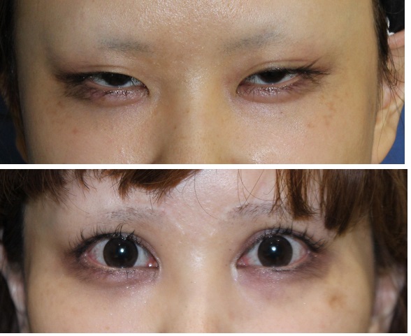 たれ眉形成術、眼瞼下垂修正術、目がしら切開術等_d0092965_2533927.jpg