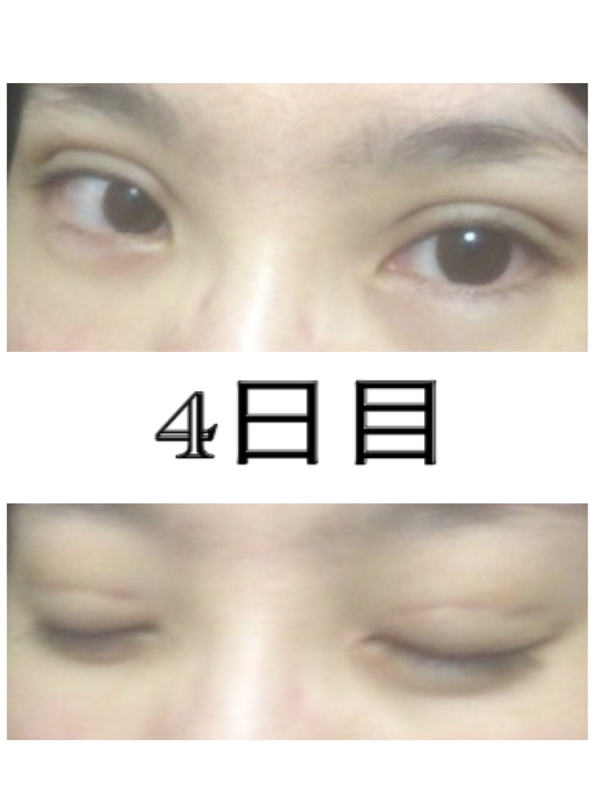 二重埋没3点留 4日目 美容整形でなんとか綺麗になりたい 二重埋没3点留 4日目 美容整形でなんとか綺麗になりたい