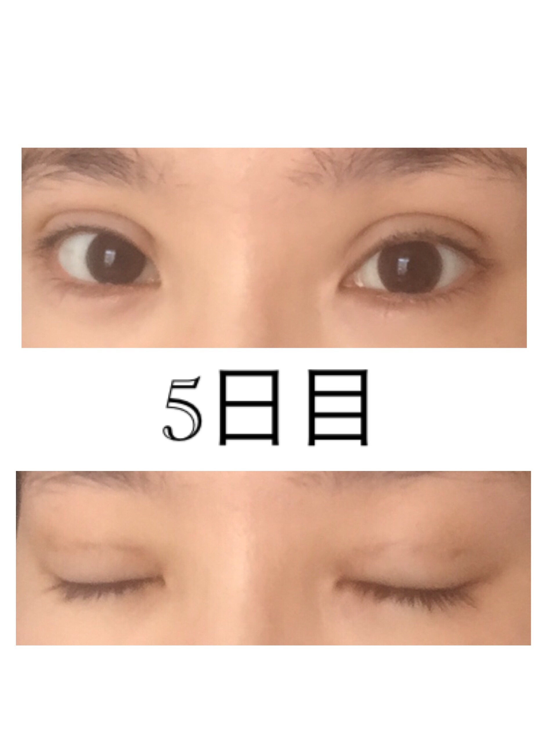 二重埋没3点留 5日目 美容整形でなんとか綺麗になりたい 二重埋没3点留 5日目 美容整形でなんとか綺麗になりたい
