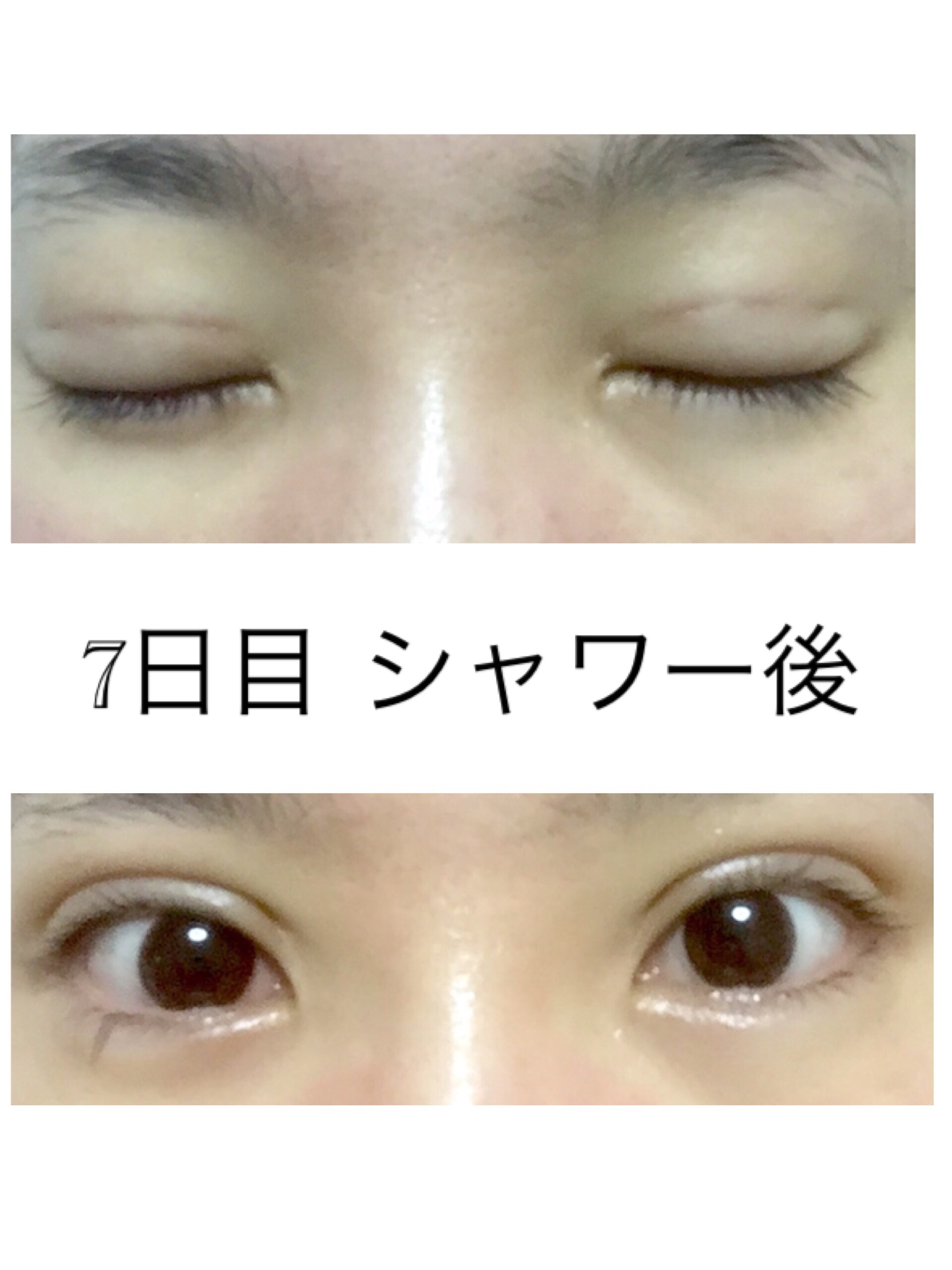 二重埋没3点留 7日目 シャワー後 美容整形でなんとか綺麗になりたい 二重埋没3点留 7日目 シャワー後 美容整形でなんとか綺麗になりたい