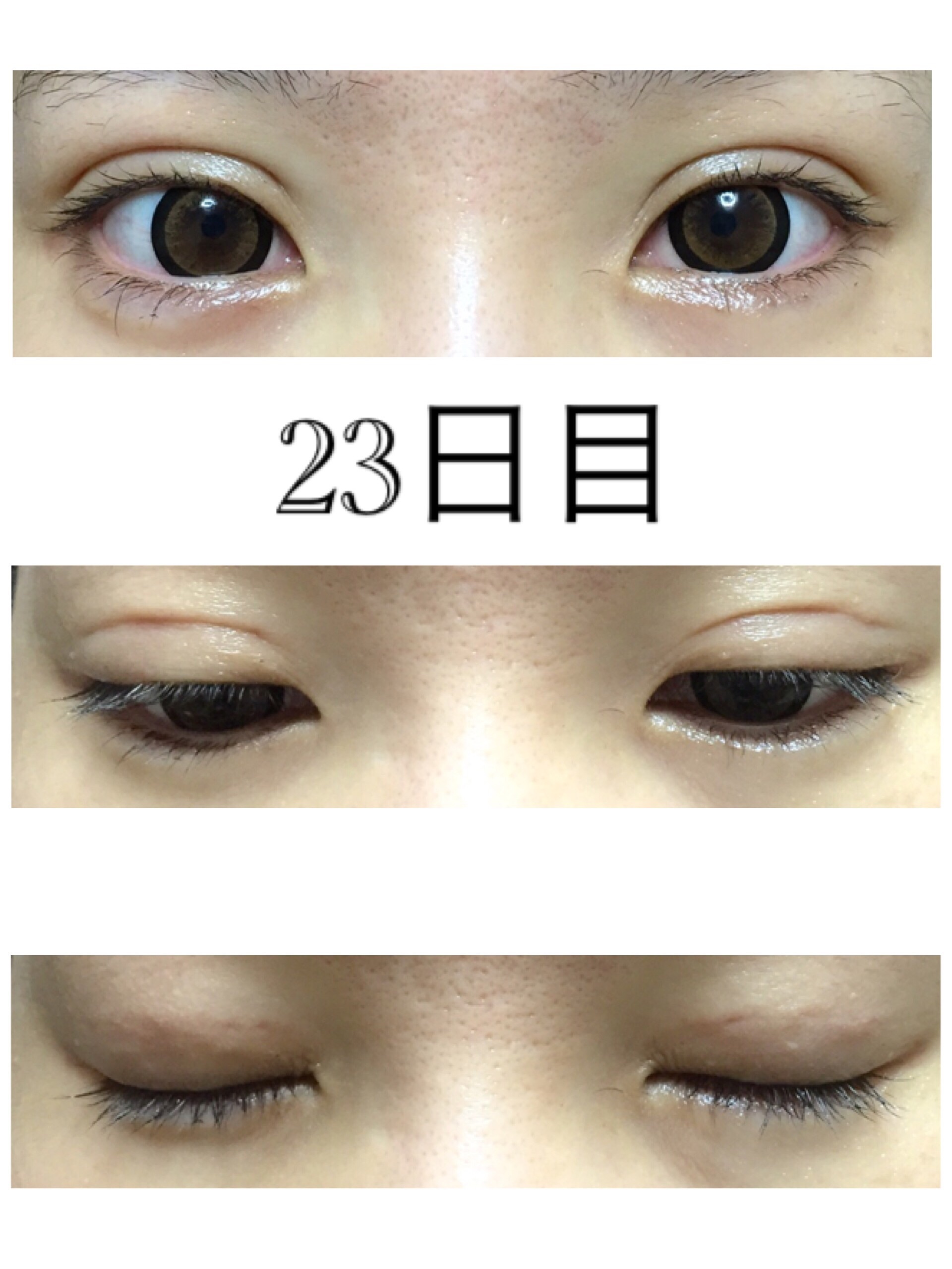 二重埋没3点留 23日目 美容整形でなんとか綺麗になりたい