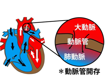 動脈管開存症_e0268036_11391375.png