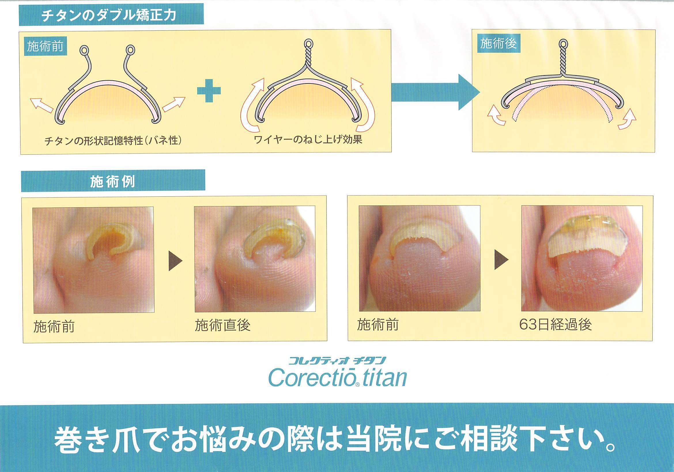 陥入爪 巻き爪の治療 かじ皮フ科クリニック院長ブログ