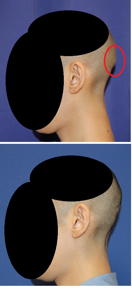 頭蓋形態修正術 後頭隆起削り 美容外科医のモノローグ