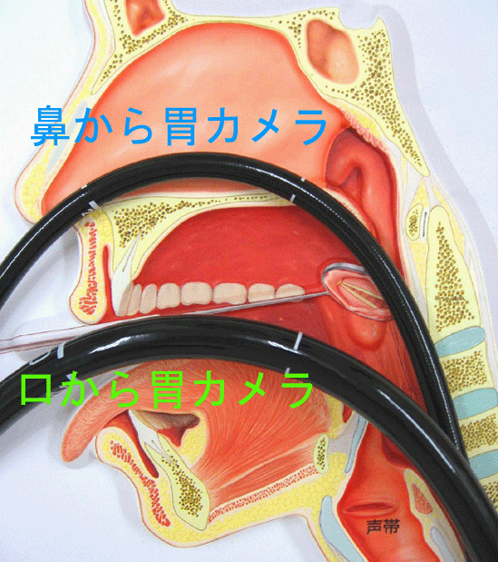 初・胃カメラ_f0172281_675598.gif