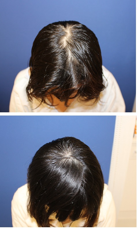 後頭部アパタイト形成術 (絶壁頭修正術)_d0092965_419585.jpg