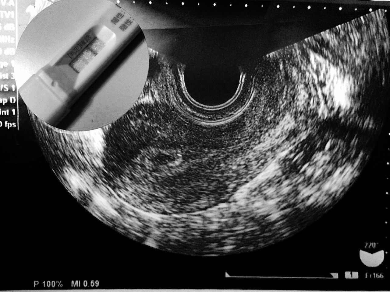 子宮 外 妊娠 ブログ