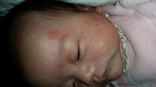 乳児湿疹（松浦）_f0354314_22511982.jpg