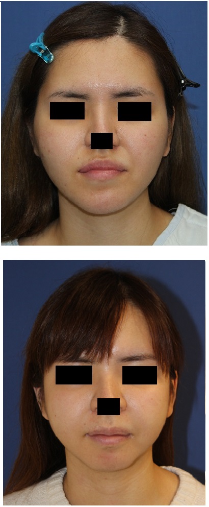 中顔面短縮術（ルフォーⅠ型骨切術、下顎矢状分割）+頬骨、顎先骨切術_d0092965_4323567.jpg