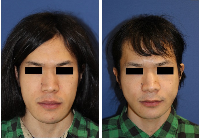中顔面短縮術　（ルフォーⅠ型骨切術+下顎矢状分割術（ＳＳＲＯ））_d0092965_093222.jpg