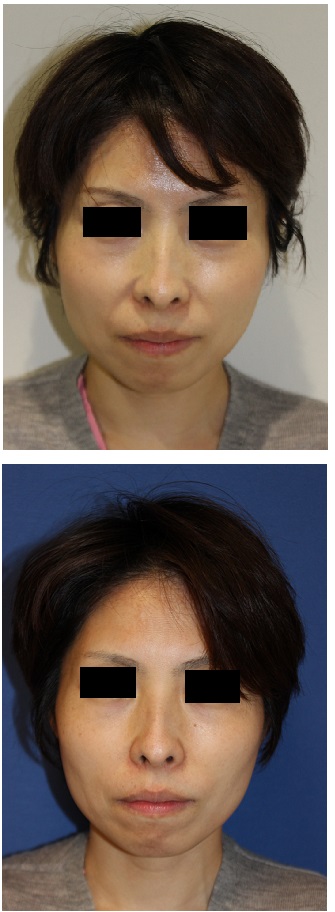 ハイフ(HIFU:high intensity focused ultrasound)によるリフトアップ_d0092965_324761.jpg