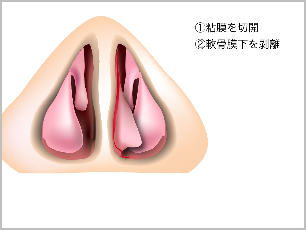 鼻中隔彎曲症_e0084756_21425584.jpg