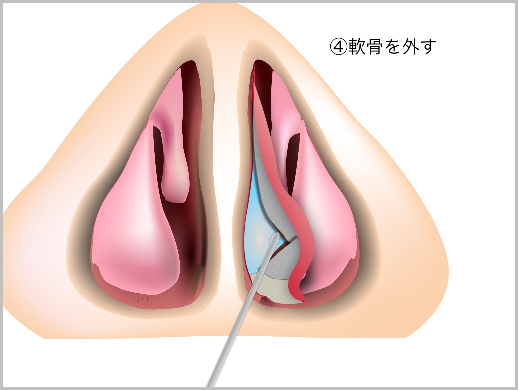 鼻中隔彎曲症_e0084756_21433185.jpg