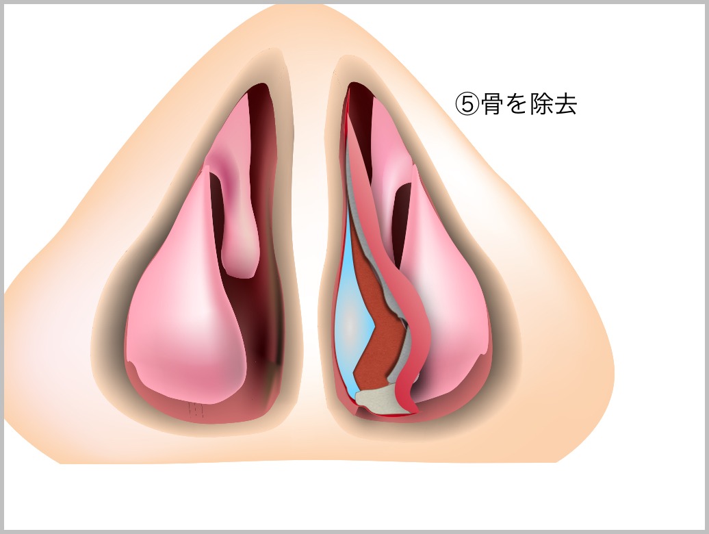 鼻中隔彎曲症_e0084756_21434993.jpg