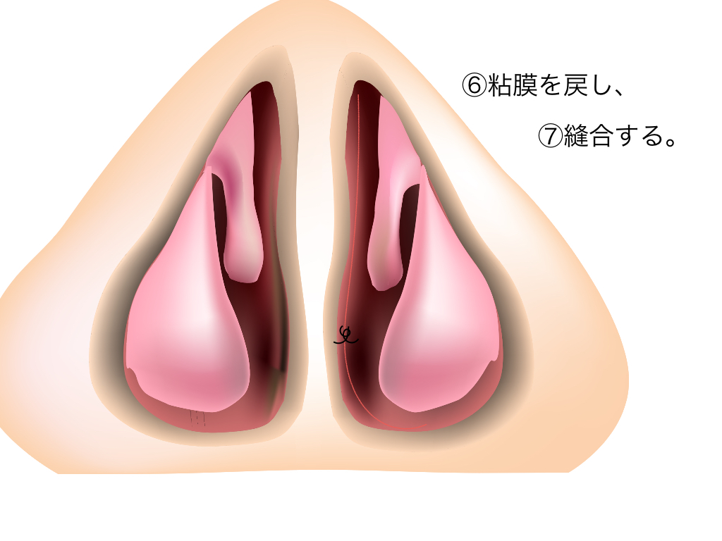 鼻中隔彎曲症_e0084756_23444094.jpg