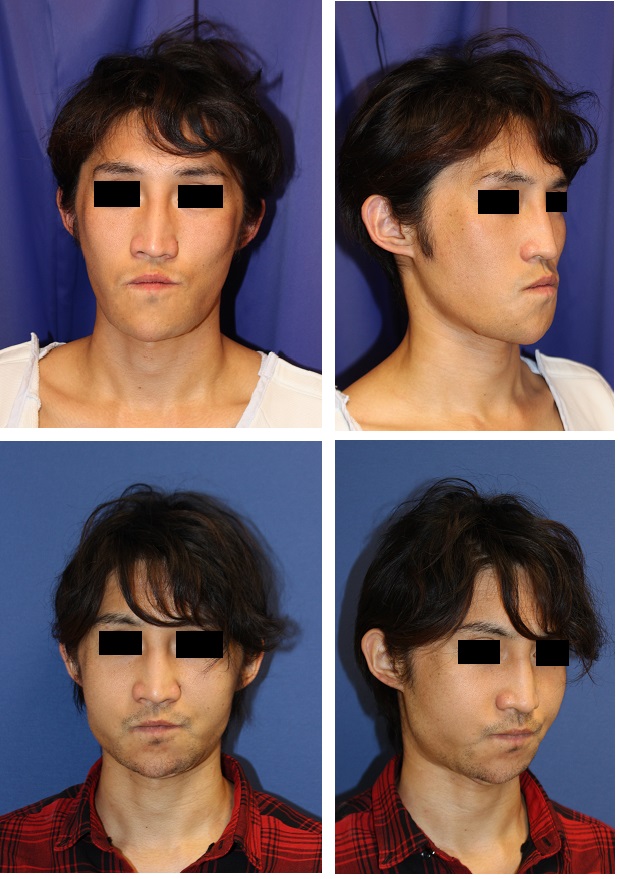 中顔面短縮術 ルフォー 型骨切術 ｓｓｒｏ 美容外科医のモノローグ