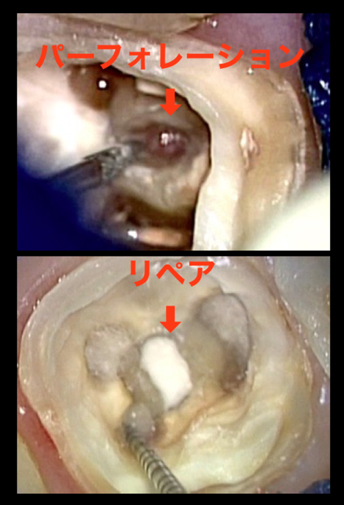 最後の砦　髄床底パーフォレーション穿孔根分岐炎症症例　　東京職人歯医者_e0004468_536597.png