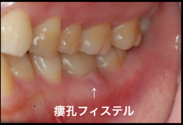 最後の砦　髄床底パーフォレーション穿孔根分岐炎症症例　　東京職人歯医者_e0004468_7283931.png