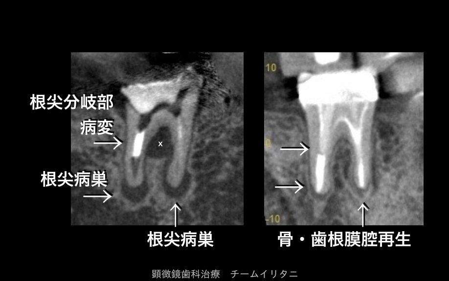 抜かないインプラントにしないために。CBCTと顕微鏡の有用性_e0004468_6503041.png