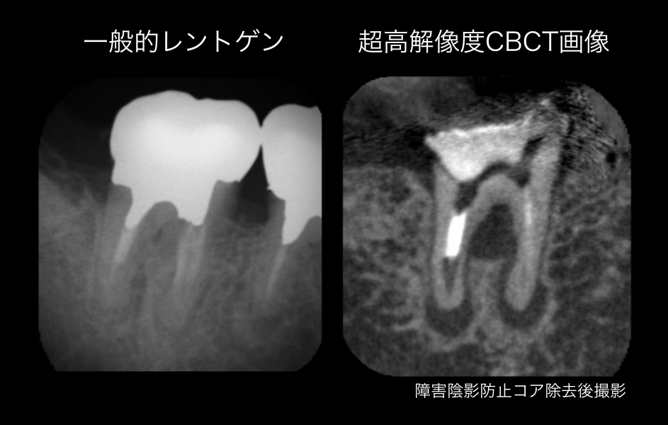 抜かないインプラントにしないために。CBCTと顕微鏡の有用性_e0004468_7382631.png