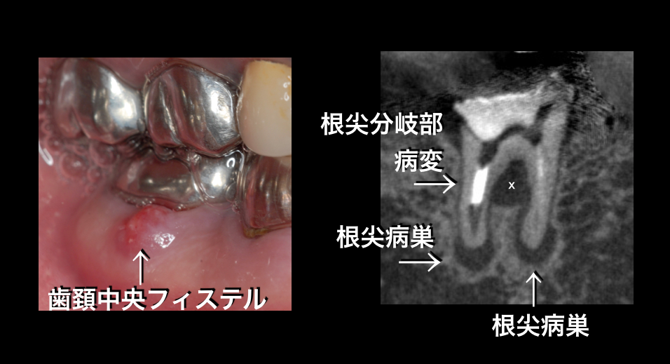 抜かないインプラントにしないために。CBCTと顕微鏡の有用性_e0004468_711694.png