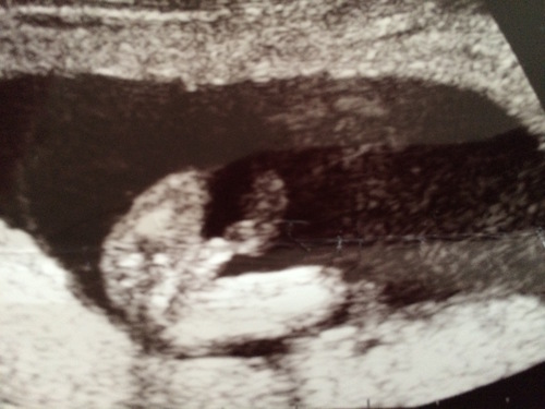 14w4d 1ヶ月ぶりの産科検診 早くも性別判明 44歳妊娠45歳出産 超高齢妊娠のブログ