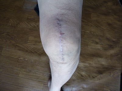 抜釘手術の一ヶ月後 膝蓋骨骨折の記録 抜釘手術の一ヶ月後 膝蓋骨骨折の記録
