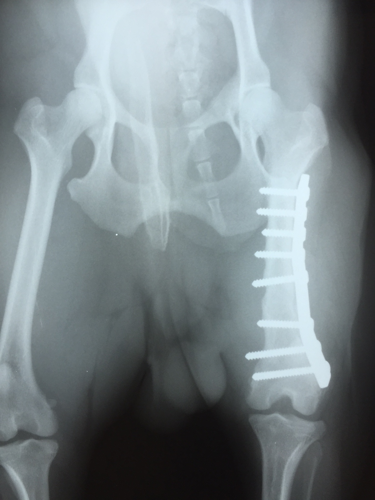 大腿骨転子部骨折の手術とリハビリの進め方。注意点についても解説 - かずぼーのリハビリ大全