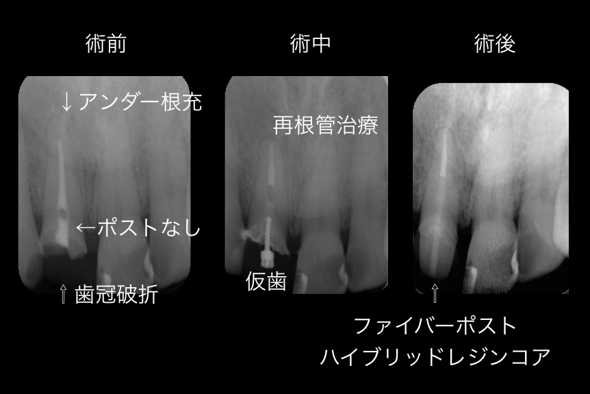 顕微鏡がなかったら抜歯の可能性大　東京職人歯医者_e0004468_0152519.png