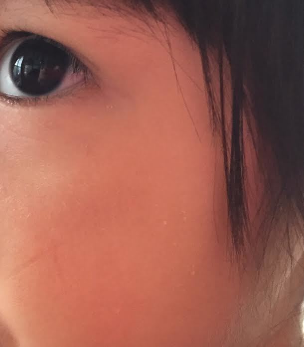ふたたび顔に傷 Halss Clinic ふたたび顔に傷 Halss Clinic