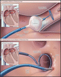 心房細動に対するクライオ(冷凍）バルーンアブレーションの有効性と安全性：NEJM誌_a0119856_9244687.gif