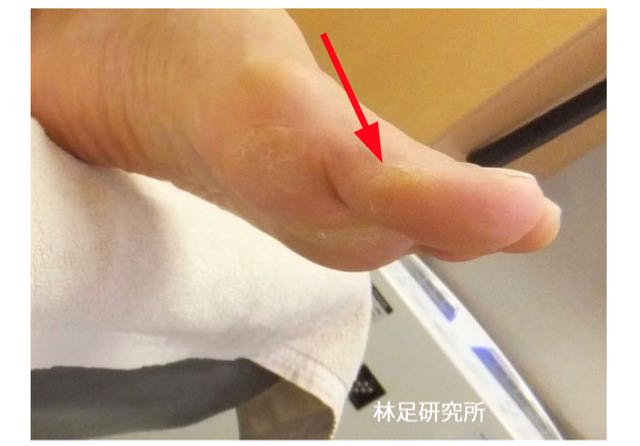 親指の付け根の固くて痛い角質 林足研究所 足 外反母趾 修正 日常の日記 親指の付け根の固くて痛い角質 林足研究所 足 外反母趾 修正 日常の日記
