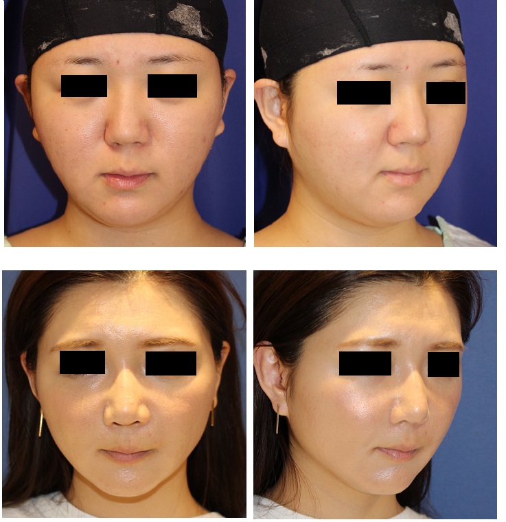 鼻中隔延長術、鼻尖縮小術、眉間プロテーゼ、鼻翼基部アパタイト、BNLS注射_d0092965_1202979.jpg