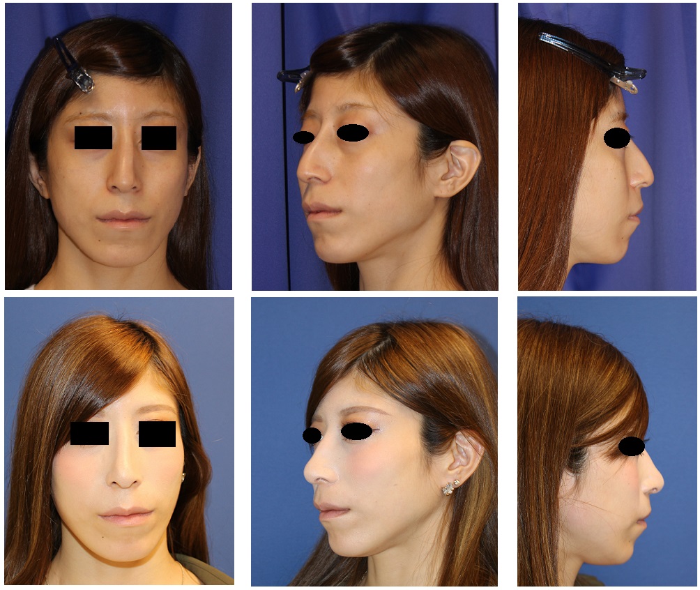 他院鼻骨削り、鼻プロテーゼ留置術、ハンプ削り、斜鼻修正術、小鼻縮小術、鼻尖縮小術 術後修正術_d0092965_371540.jpg