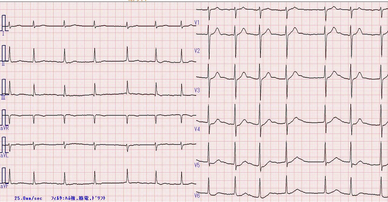 心電図にも顔がある：日本医事新報「プラタナス〜私のカルテから〜」より_a0119856_15443679.jpg