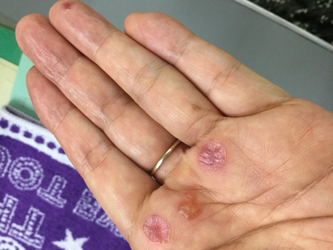 イラガに刺された 追記有り イラガに刺された 追記有り