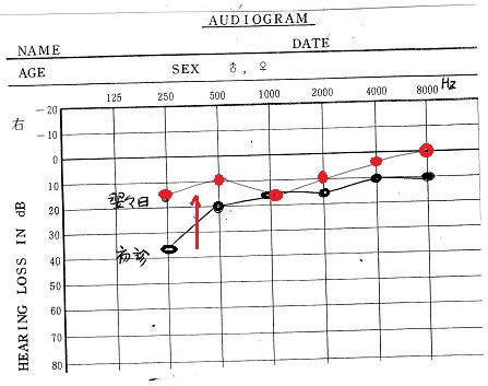 メニエール病_a0082724_21175841.jpg