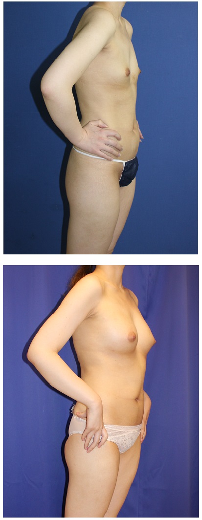 脂肪移植豊胸術　術後　１年４か月_d0092965_1364615.jpg