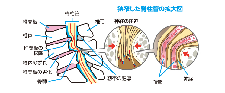 座骨神経痛_e0097212_11245246.jpg
