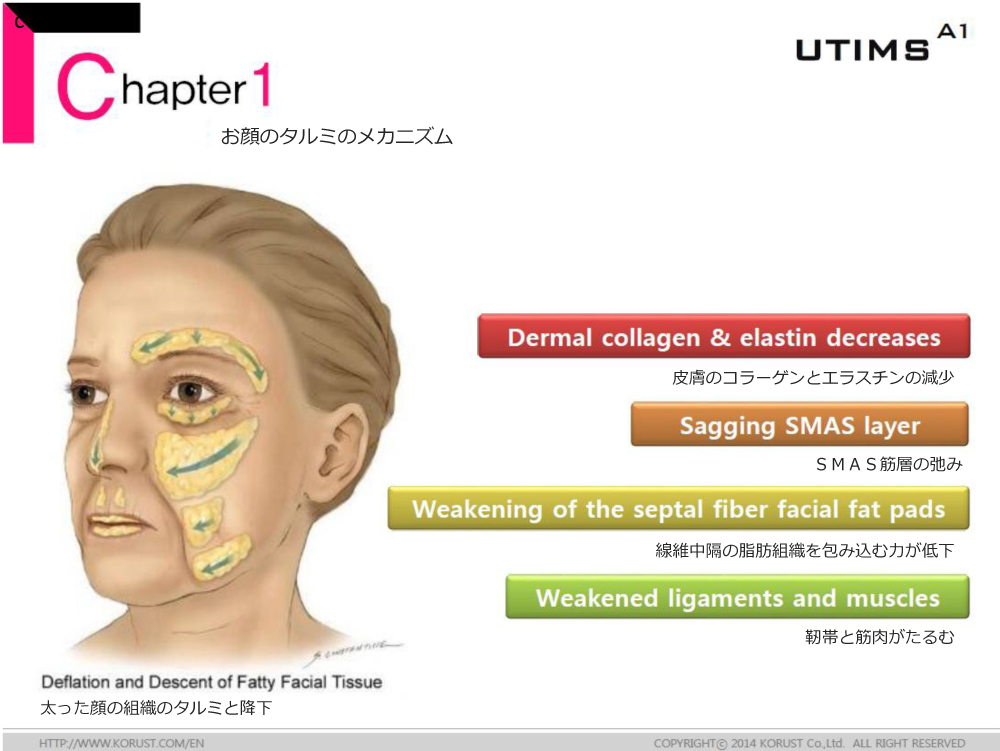 切らずにフェイスリフト 新しいHIFU機器 :UTIMS_d0105660_12263825.jpg