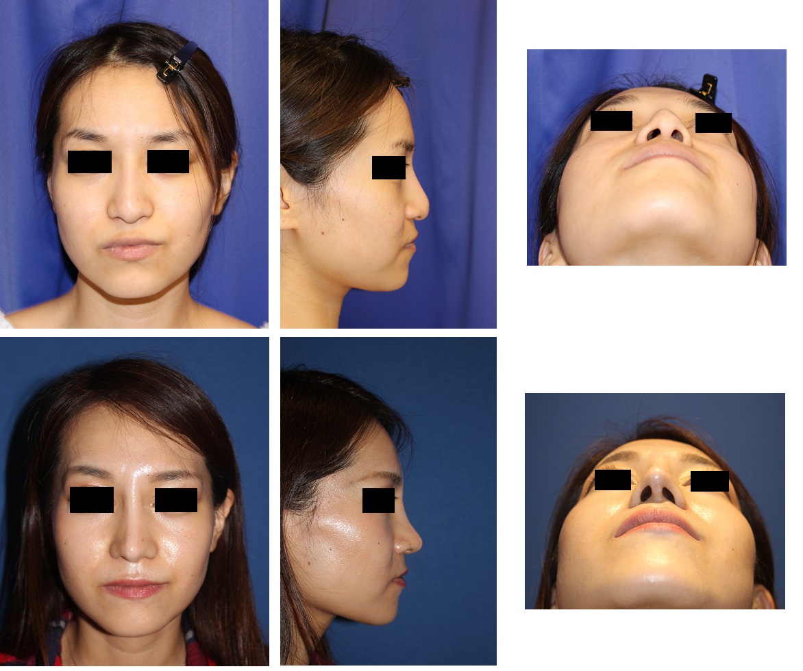 他院鼻プロテーゼ術後入れ替え、鼻中隔延長術、鼻尖縮小術、小鼻縮小術、眉間プロテーゼ_d0092965_1172762.jpg