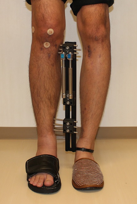 ディバスティアーニ変法　左脚延長術 術後約７か月 ，右術後約１か月_d0092965_3384433.jpg