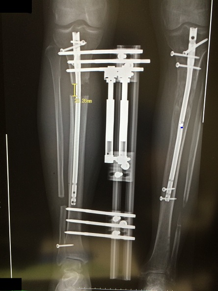 ディバスティアーニ変法　左脚延長術 術後約７か月 ，右術後約１か月_d0092965_3393124.jpg