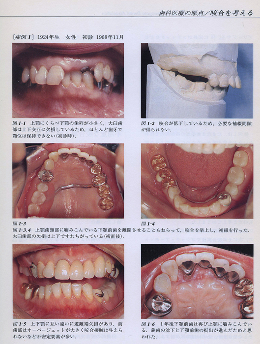 過蓋咬合とDeep over bite_f0103459_15292714.jpg