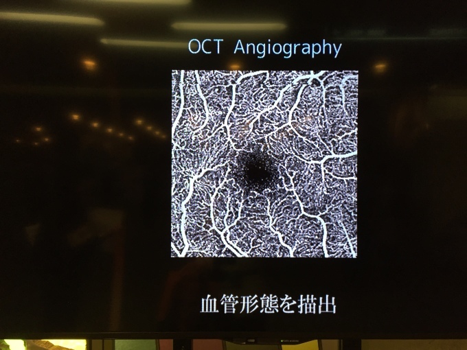 OCT Angiography_d0131804_17383360.jpg