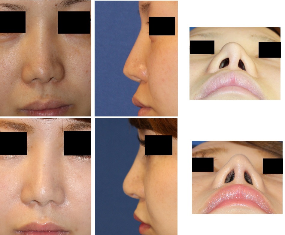 鼻孔形態修正術、鼻尖部軟骨除去　，鼻先婦人科軟部組織移植_d0092965_518129.jpg