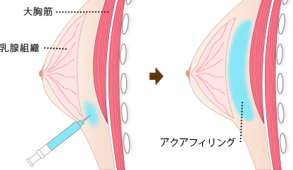 ２０代女性の「アクアフィリング(AQUA filling)注入豊胸」手術後１ヶ月目の変化です。_c0267589_1483989.png