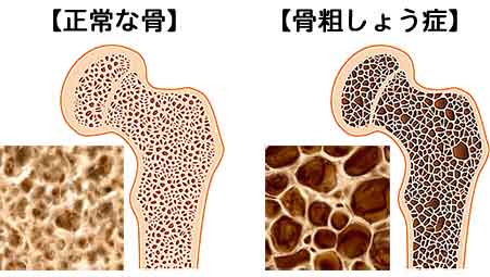 骨粗鬆症のような事が髪にも　高円寺｜美容室envie_f0216597_17164027.jpg